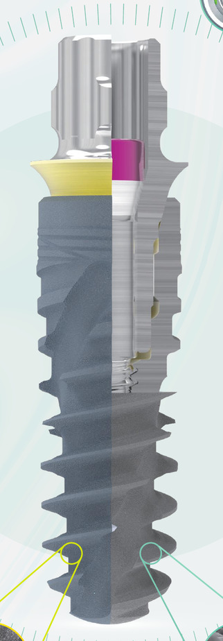 B-L-T Plus implant cutaway